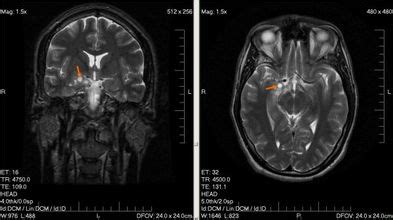 guz mozgu objawy diagnostyka rodzaje leczenie wp abczdrowie