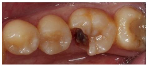 dentistry journal  full text restoring large defect  posterior tooth  indirect