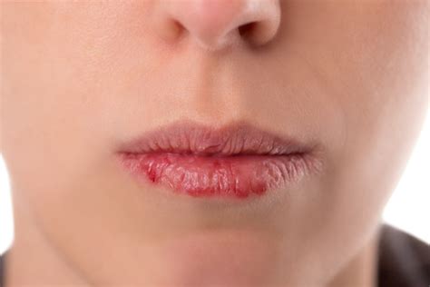 Bagaimana Cara Ampuh Mengatasi Bibir Kering Hello Sehat