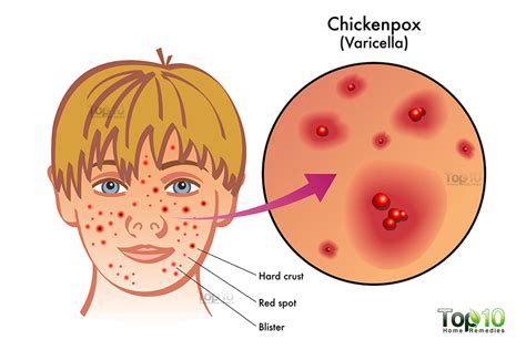 Chicken Pox Infections Apex Dermatology And Skin Surgery