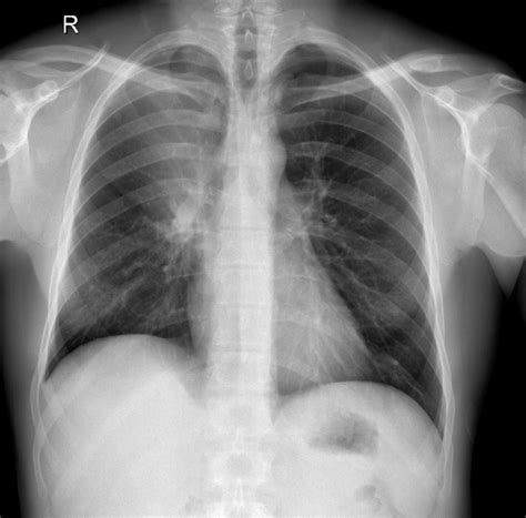 Collapse Of The Right Upper Lobe Is Usually Relatively Easy To Identify