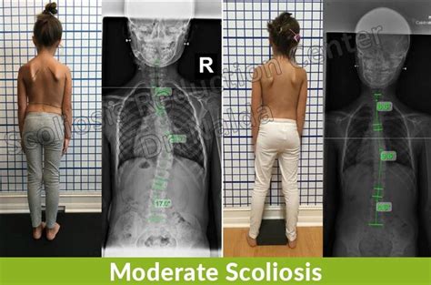moderate scoliosis