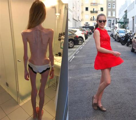 Anorexic Girl Inspires People To Get Healthy After Being