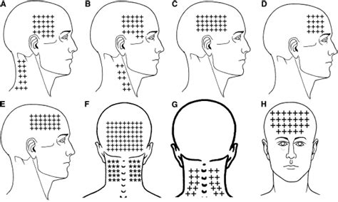 Referred Pain From Myofascial Trigger Points In Head And Neck Shoulder