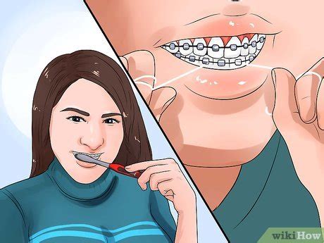 clean teeth  braces  steps  pictures wikihow