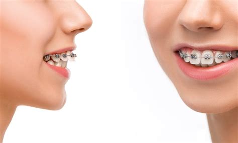 Why You Need To Know The Difference Between Overjet And Overbite