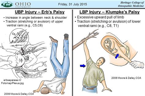 resultado de imagen de erb duchenne  klumpke erbs palsy medical knowledge erb palsy