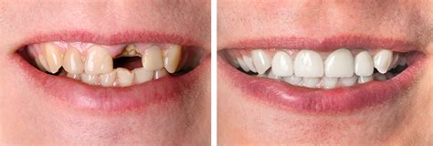 root canal  front teeth teethwalls