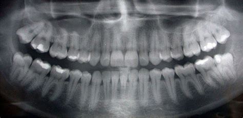 how the hell should i know dental x rays and brain cancer