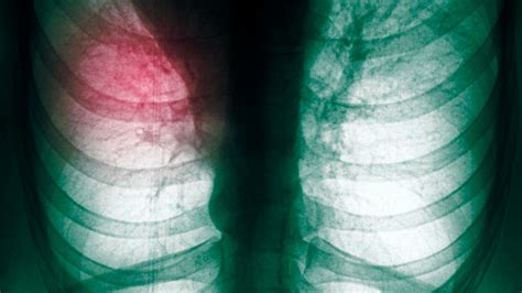 lung cancer could be detected with simple breath test huffpost uk life