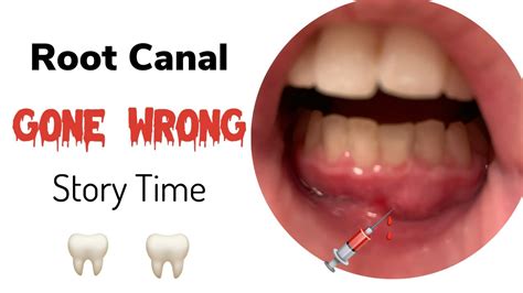 Root Canal Gone Wrong Story Time Youtube