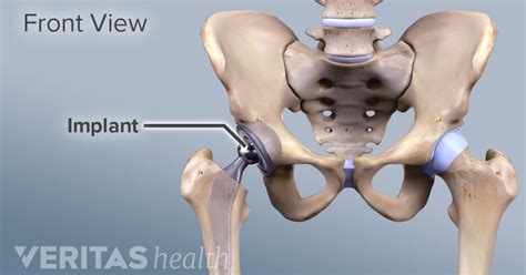 Total Knee Replacement Precautions Physical Therapy