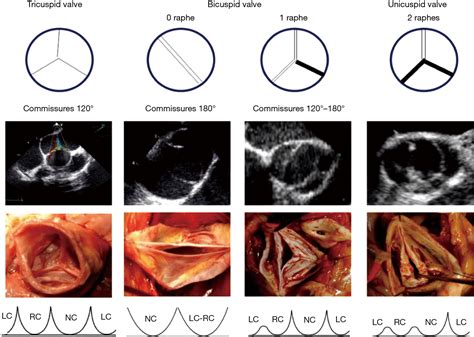 Systematic Echocardiographic Assessment Of Aortic Regurgitation—what