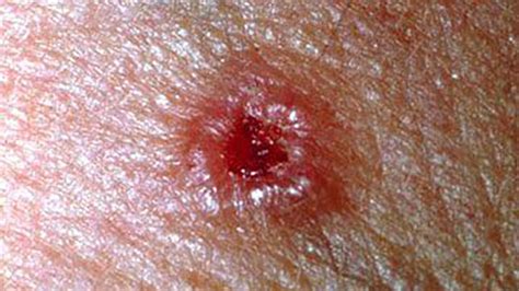 Skin Cancer Rash Itchiness And Symptoms