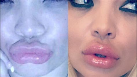 how i fixed my botched lip injections dissolver review