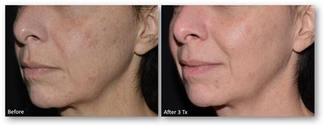 laser skin resurfacing treatments  jacksonville fl  smooth