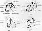 Nejm Coronary Arteriogram sketch template