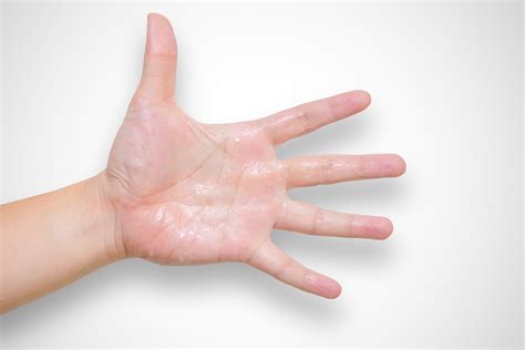 hyperhidrosis hands