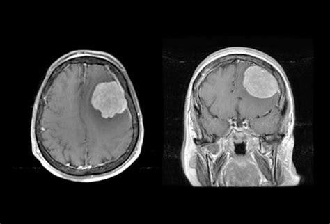 Brain Lesions 10 Cases To Test Your Management Skills