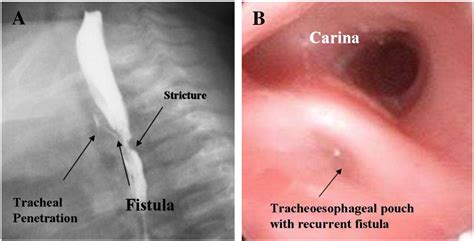 Endoscopic Management Of Recurrent Tracheoesophageal Fistula Journal