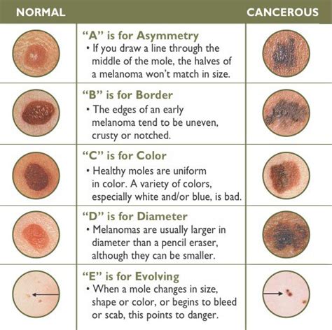 Types Of Skin Cancers Dermatologist Woodlands Houston Katy Texas