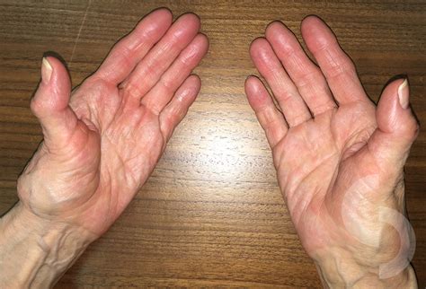 thumb basal joint arthritis dr sonja cerovac