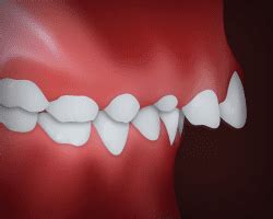 protrusion dr weber weber orthodontics