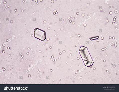 triple phosphate crystal urine sediment stock photo