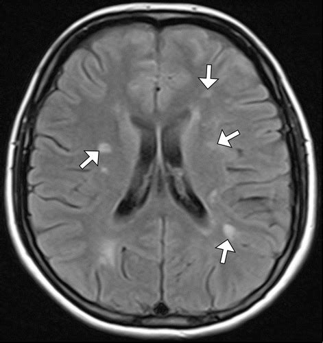 Neuroimaging Of Emergent And Reemergent Infections Radiographics