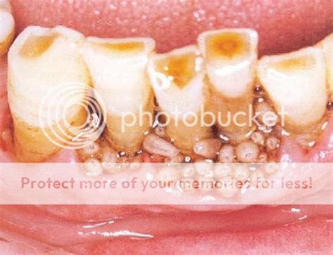 teeth maggots photo  sadlands photobucket