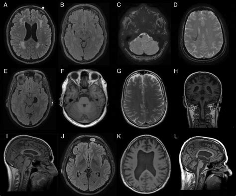 incidental findings on brain mri of cognitively normal first degree