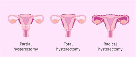What Is Hysterectomy Hysterectomy Types Procedure Risks And Recovery