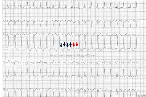 Ecg Rhythms Atrial Flutter