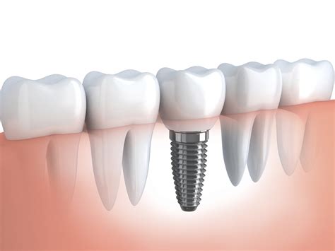 quanto custa implante de dente consulta ideal