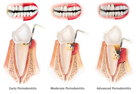 periodontal treatment ctl dental