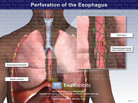 Perforation Of The Esophagus Trialexhibits Inc