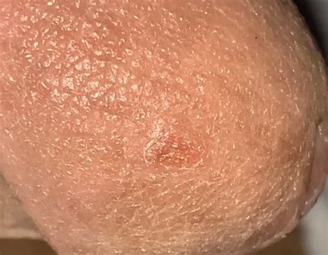 Very Small Single Red Bump Spot On Head Of Penis Penis Disorders