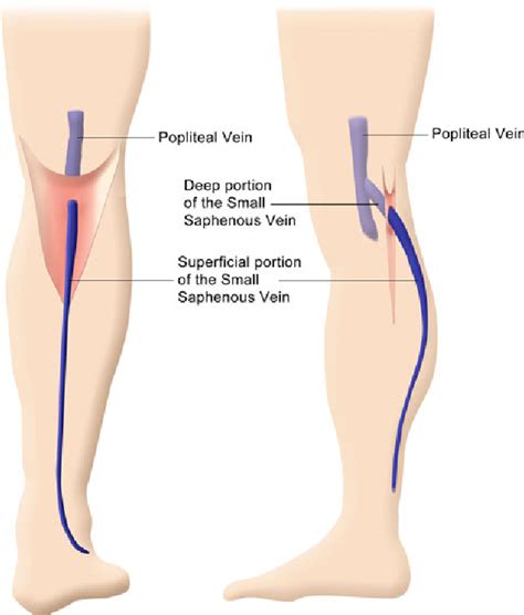 figure   endovenous laser ablation   small saphenous vein sparing  saphenopopliteal