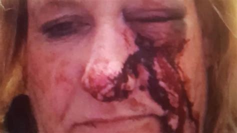 woman suffers horrific injuries after being headbutted by pal s partner