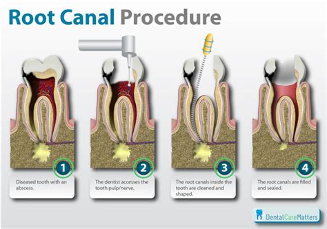 root canal procedure explained dentalcarematterscom