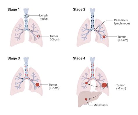 stages of lung cancer ebis medical
