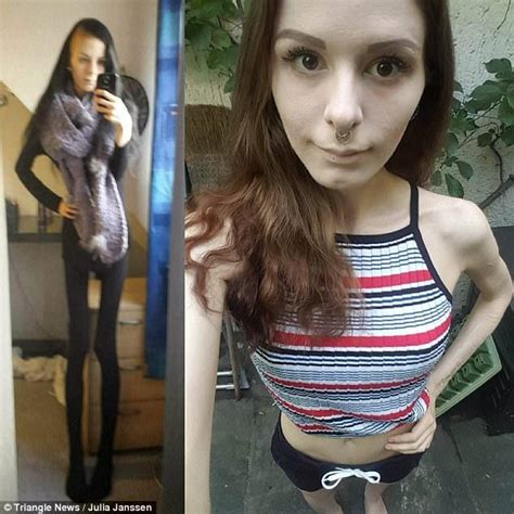 Foto şocant Cel Mai Grav Caz De Anorexie Din Istorie Îmi Ascundeam
