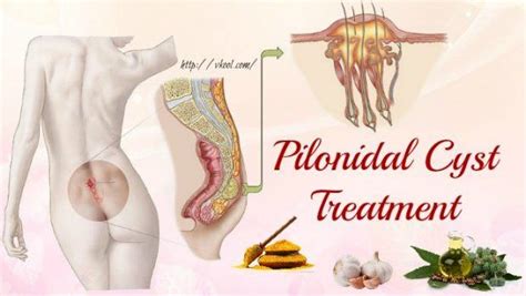 16 Tips Of Natural Pilonidal Cyst Treatment You Should Know