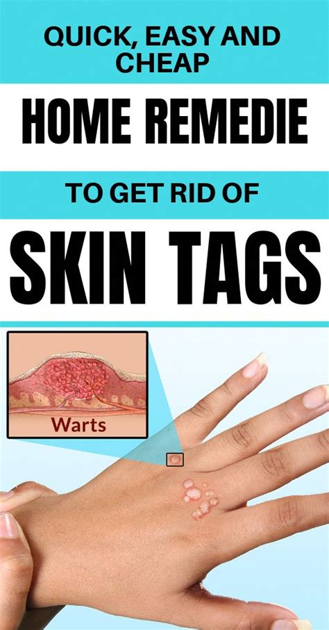 quick easy cheap home remedy to get rid of skin tags