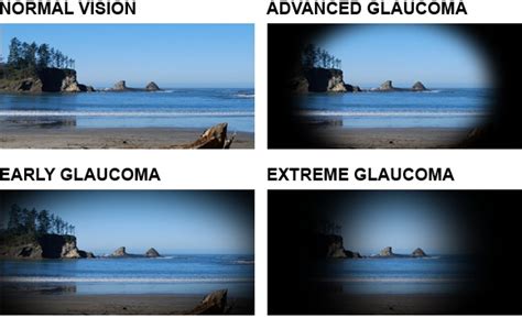glaucoma testing  treatment lees summit eye doctor