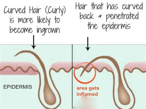 ingrown hair  herpes ingrown hair  herpes whats  difference