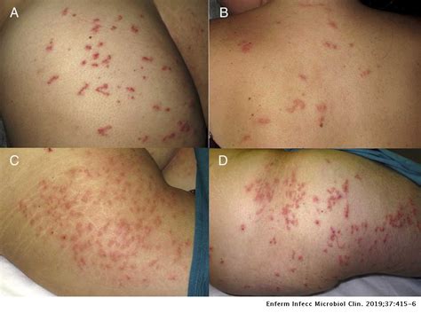 Response To Oral Ivermectin In Three Cases Of Follicular Cutaneous