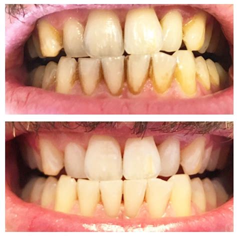 stain removal  teeth whitening    brighter smile