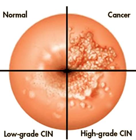 Cervical Cancer Pictures