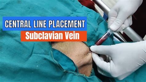 central  placement subclavian vein approach youtube